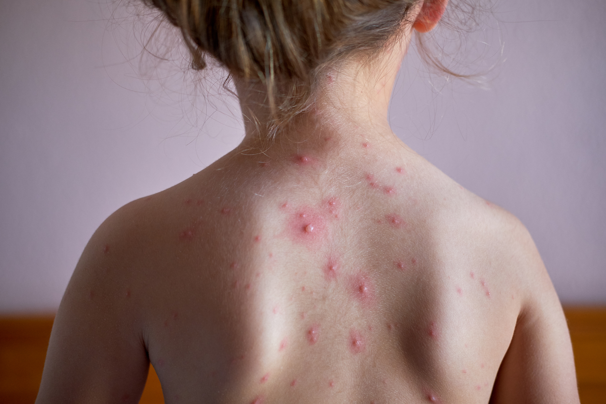 Pediatric Skin Conditions to Know About