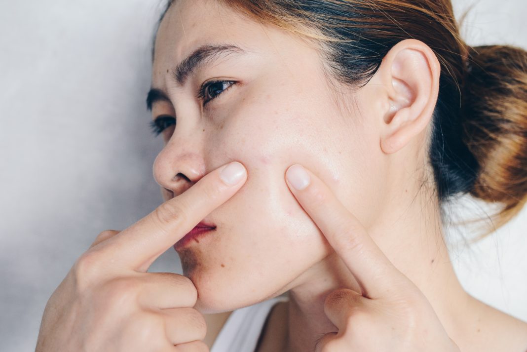 How To Get Rid Of A Popped Pimple Scar DIY Cosmetics