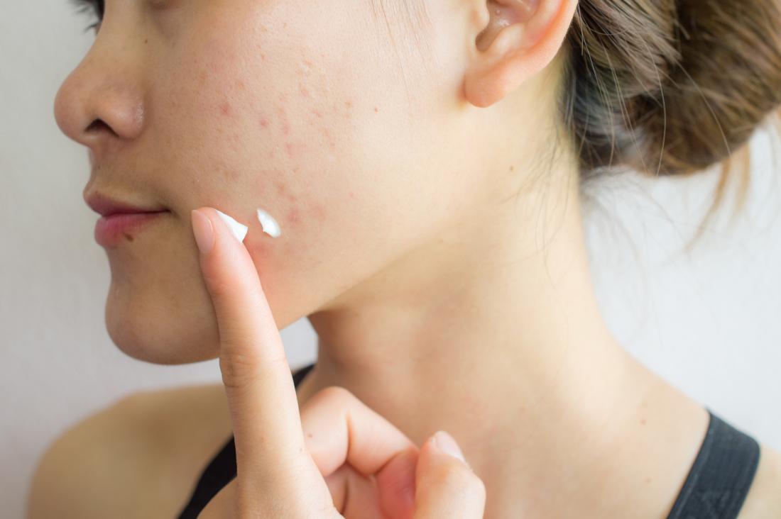 How to Get Rid of a Popped Pimple Scar