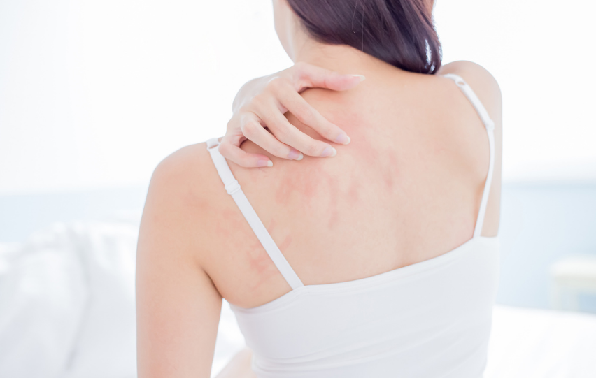 Eczema Flare Up Due to Stress – Things to Know