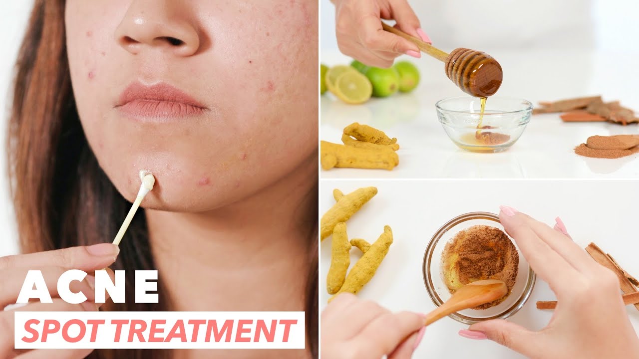 Learn How to Make Homemade Acne Spot Treatment